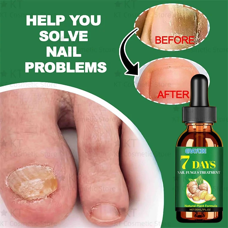 Serum Antihongos para Uñas