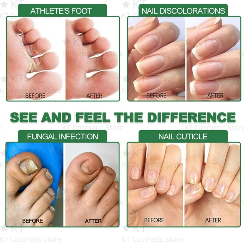 Serum Antihongos para Uñas
