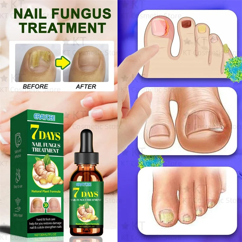 Serum Antihongos para Uñas